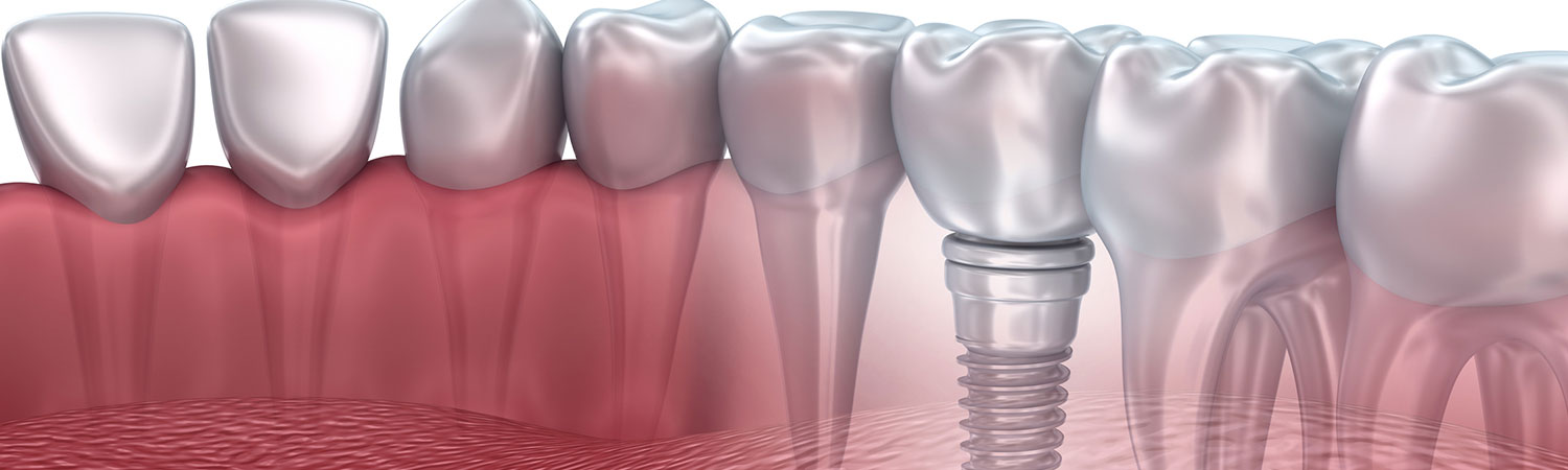 images/banner-dental-implants.jpg