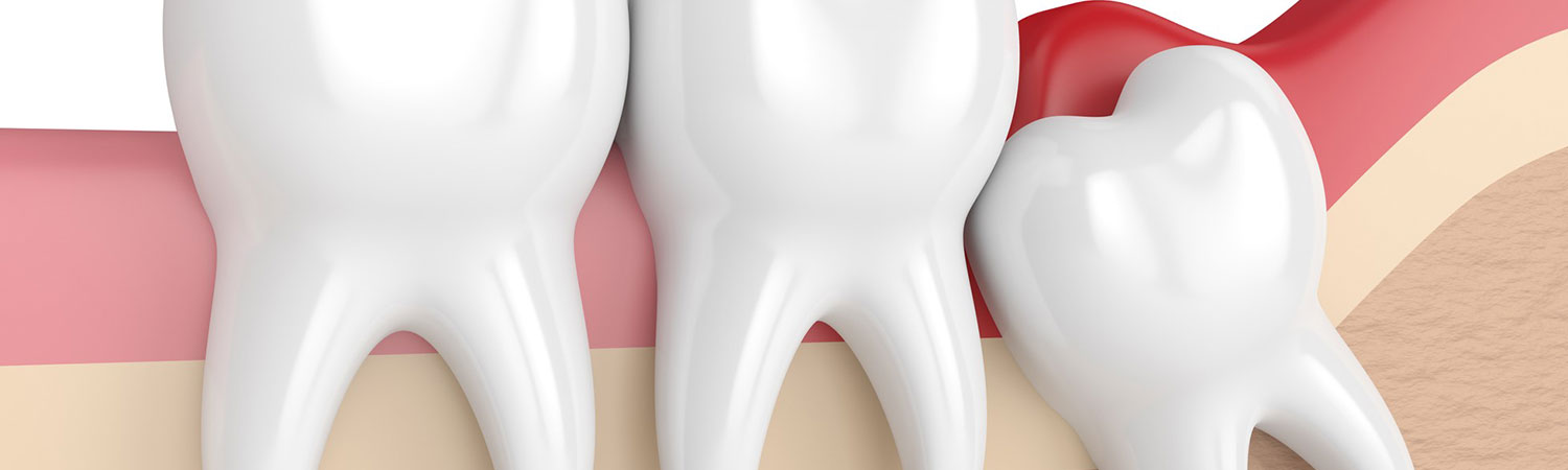 images/banner-wisdom-teeth-removal.jpg