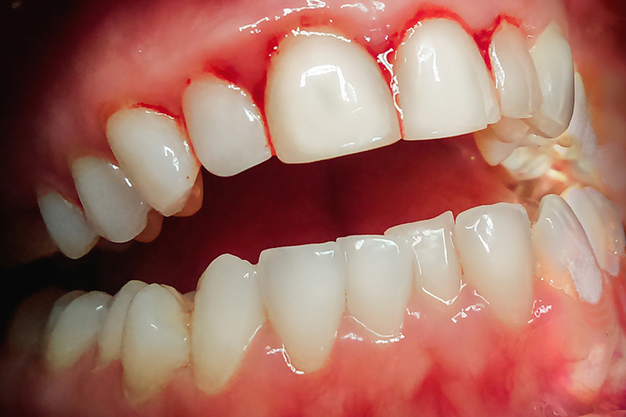 The Importance of Healthy Gums: Prevention & Treatment of Periodontal Disease