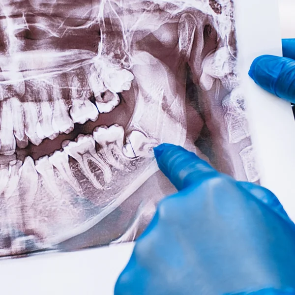gloved hand pointing to impacted wisdom tooth on X-ray
