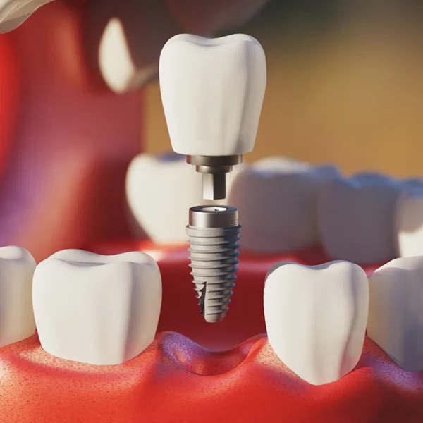 3D illustration of dental implant