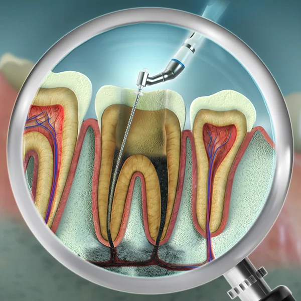 3D illustration of root canal procedure