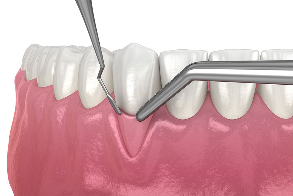 Dental care on the tooths