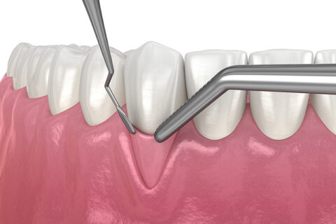 Dental care on the tooths