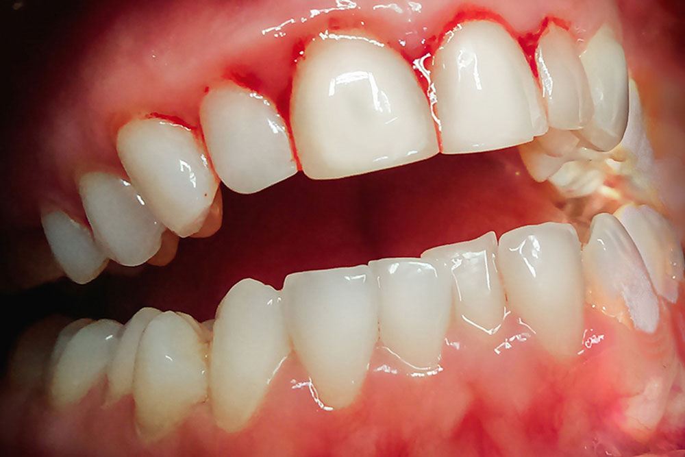 Bleeding gums on the teeth