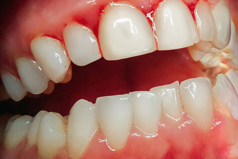 Bleeding gums on the teeth